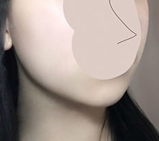 Hiệu quả căng chỉ quá ổn