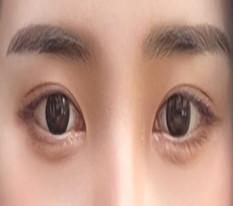 Chỉ tạo đường mí thôi mà ai cũng khen xinh lol