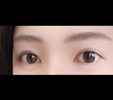 Sửa mí hạ line cho mắt lệch