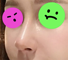 Một tháng sau mổ mũi, hoàn toàn hài lòng^^