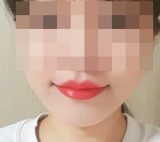 Khóe miệng Cupid + gò môi