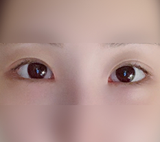 Hóa ra đây là lý do người ta làm dual canthoplasty haha