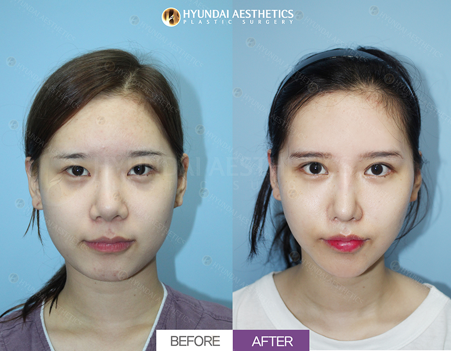 Sửa mí đôi bằng đường rạch + chỉnh cơ nâng mi + mở khóe mắt trong + mở khóe mắt kép