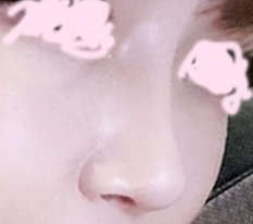Review sau khi sửa lại mũi~