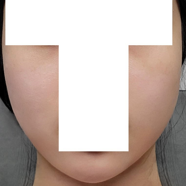 Sagging facial fat was perfectly improved with thread lifting