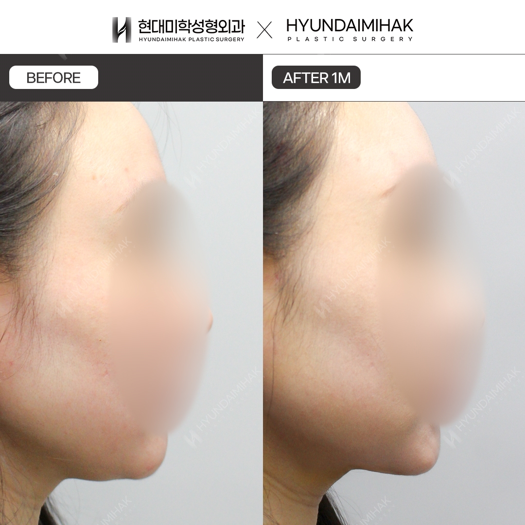Căng chỉ nọng cằm sau 1 tháng