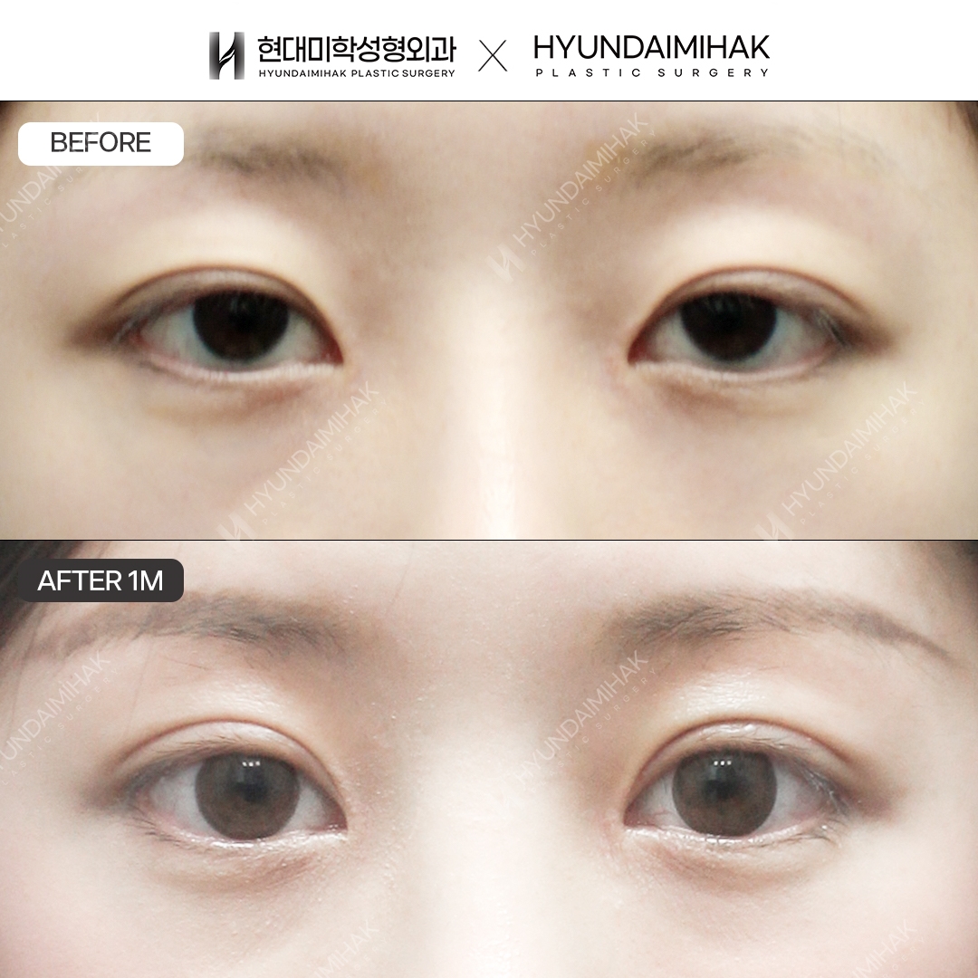[Tái phẫu thuật mắt] Nhấn mí không rạch
