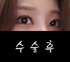 I had revision ptosis correction and canthoplasty all at once this time, please look
