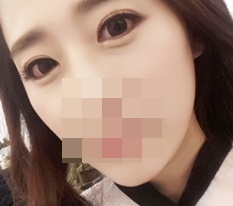 Highly recommend Thẩm mỹ Hyundai eye-shape correction!~♥
