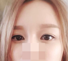 Hài lòng với ca phẫu thuật mắt lại~