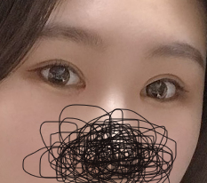 They really deserve the nickname canthoplasty specialist~ Thẩm mỹ Hyundai is the best!