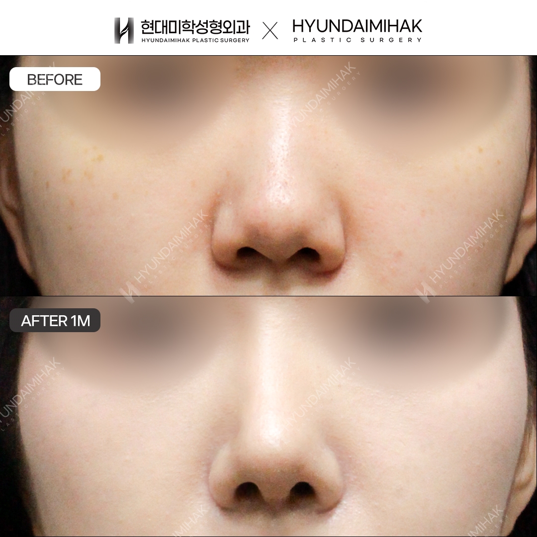 [Tái phẫu thuật mũi] Sống mũi + đầu mũi, sau 1 tháng