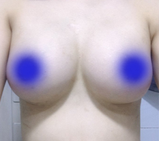 Breast surgery review~ Now I love that every outfit looks pretty on me!