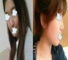 Đây mới đúng là phẫu thuật mũi thật sự!!