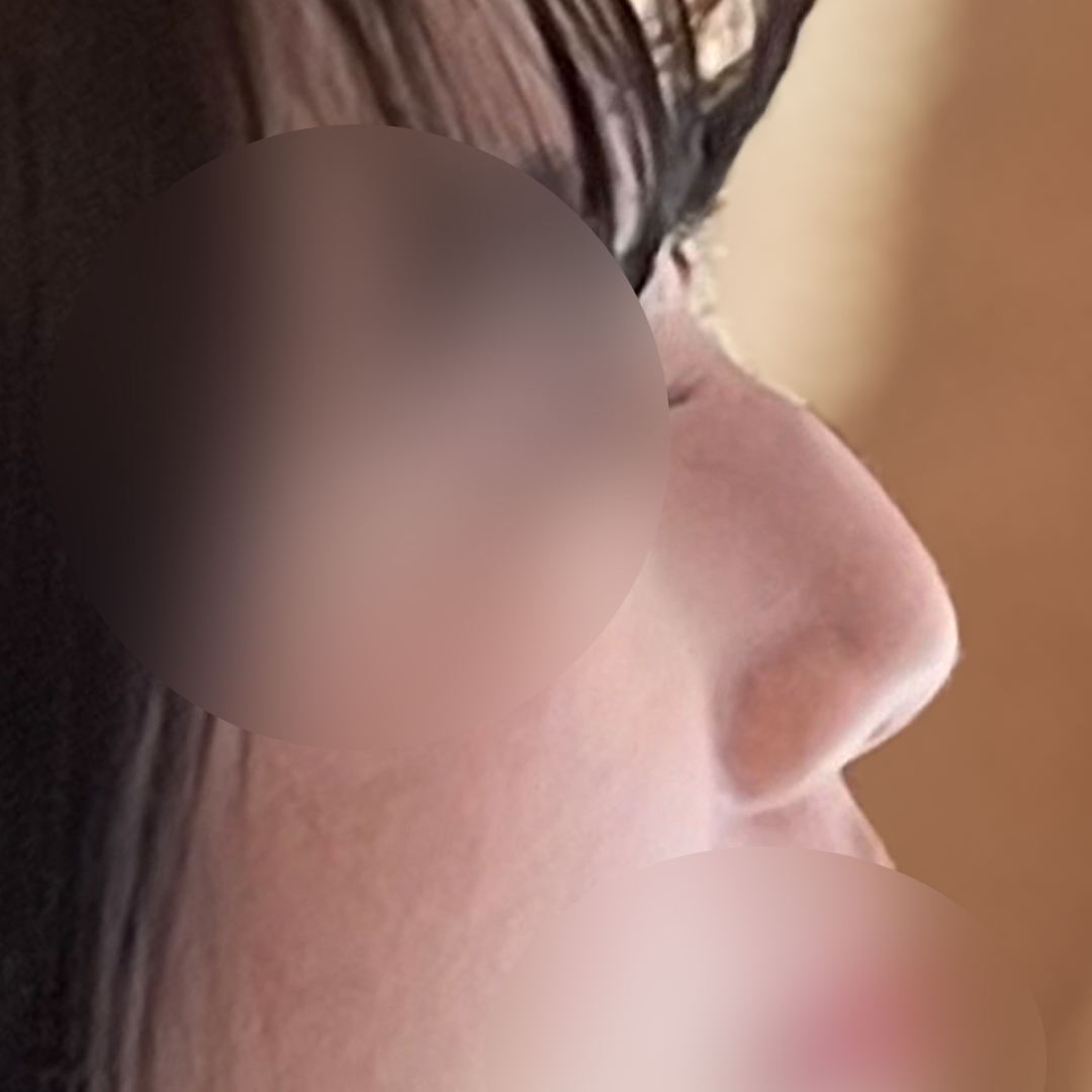 Before and after hump nose surgery