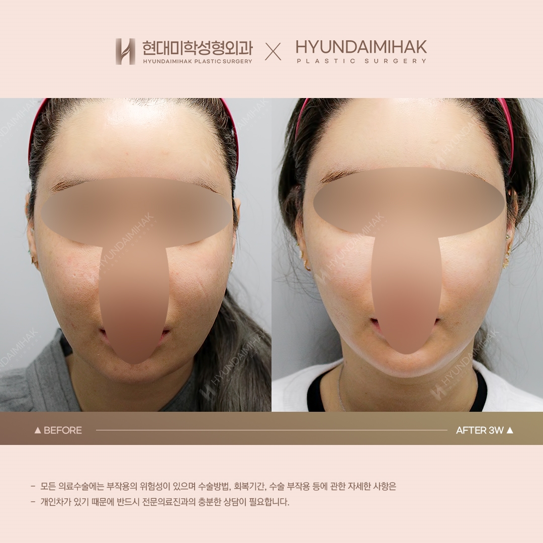 [Nâng cơ] Căng chỉ nọng cằm sau 3 tuần