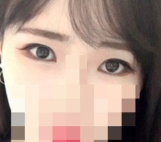 Totally satisfied with Thẩm mỹ Hyundai eye-shape correction♥