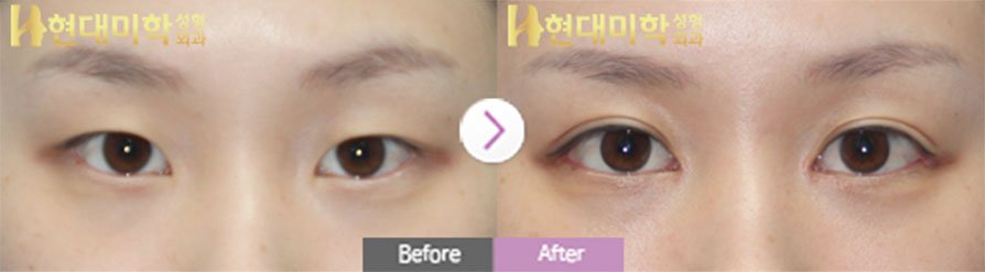Phẫu thuật mắt, nhấn mí, mở góc mắt trong, ngoài và hạ đuôi mắt