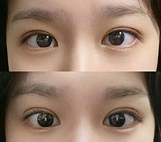 Mình đã làm phẫu thuật chỉnh mí dính tự nhiên