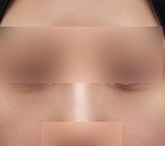 Tái bố trí mỡ dưới mắt đỉnh thật~