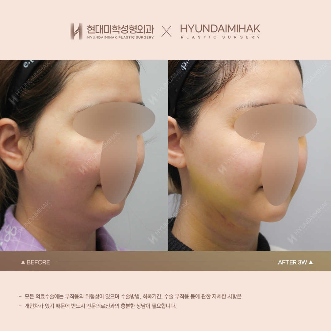 [Nâng cơ] Căng chỉ vùng nọng cằm tuần thứ 3