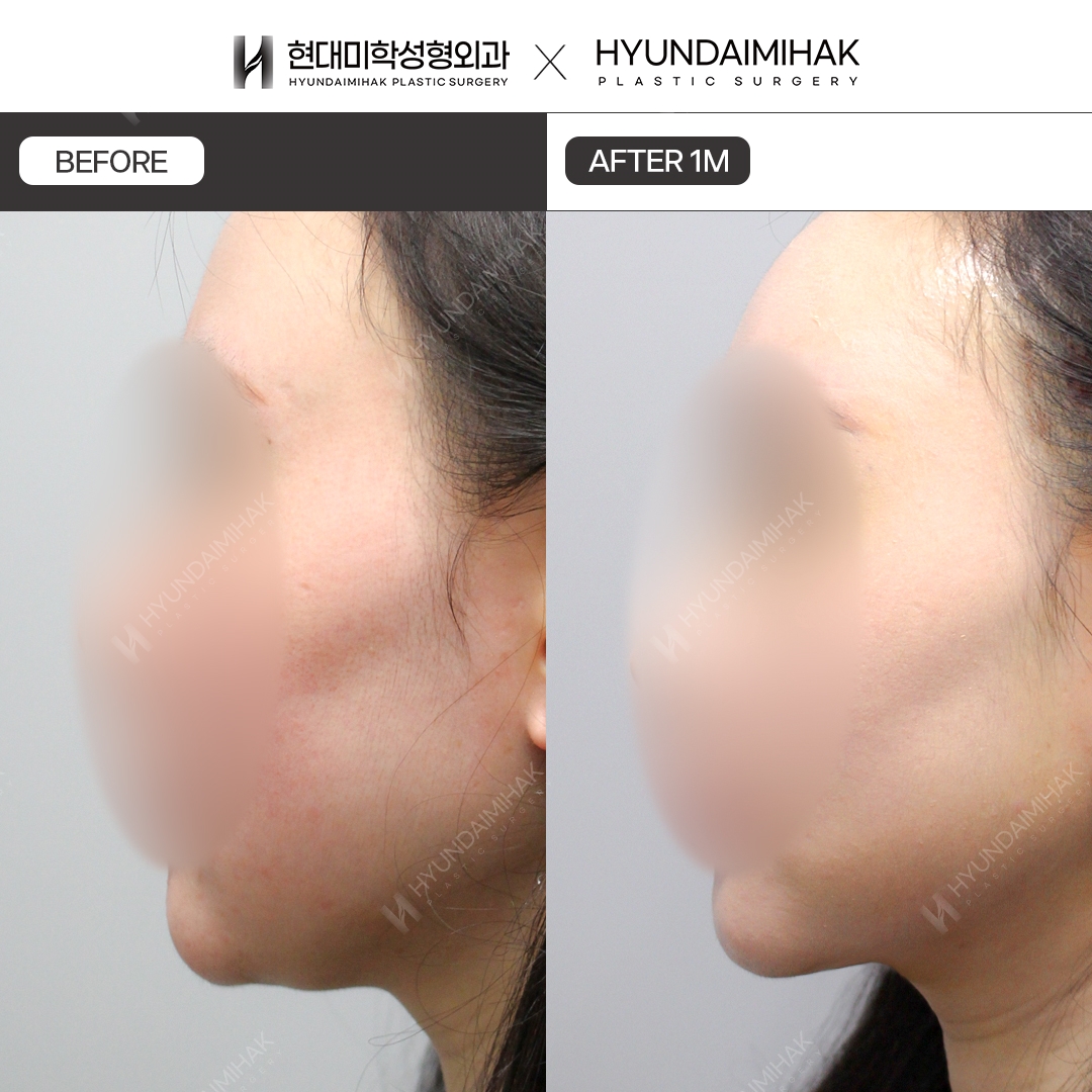 [Phẫu thuật trẻ hóa] Căng chỉ sau 1 tháng