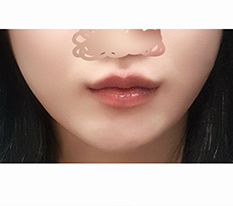 Phẫu thuật nâng góc môi thay vì tiêm botox