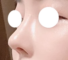 Nhờ phẫu thuật mũi mà tôi được khen xinh hơn rất nhiều