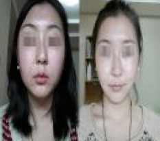 Xử lý tạp sắc và nâng cơ vùng cằm chảy xệ ^^
