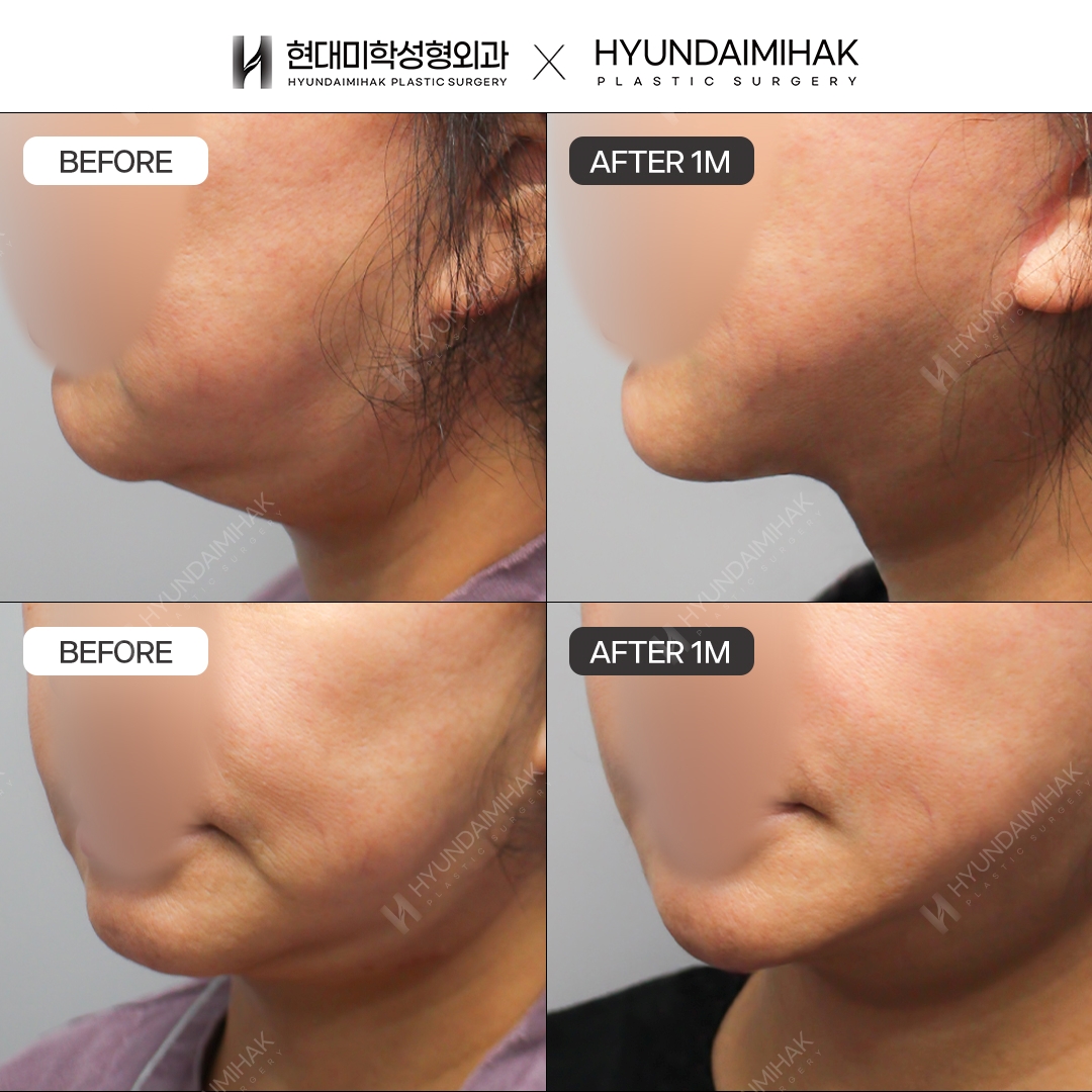 [Phẫu thuật trẻ hóa] Căng chỉ sau 1 tháng