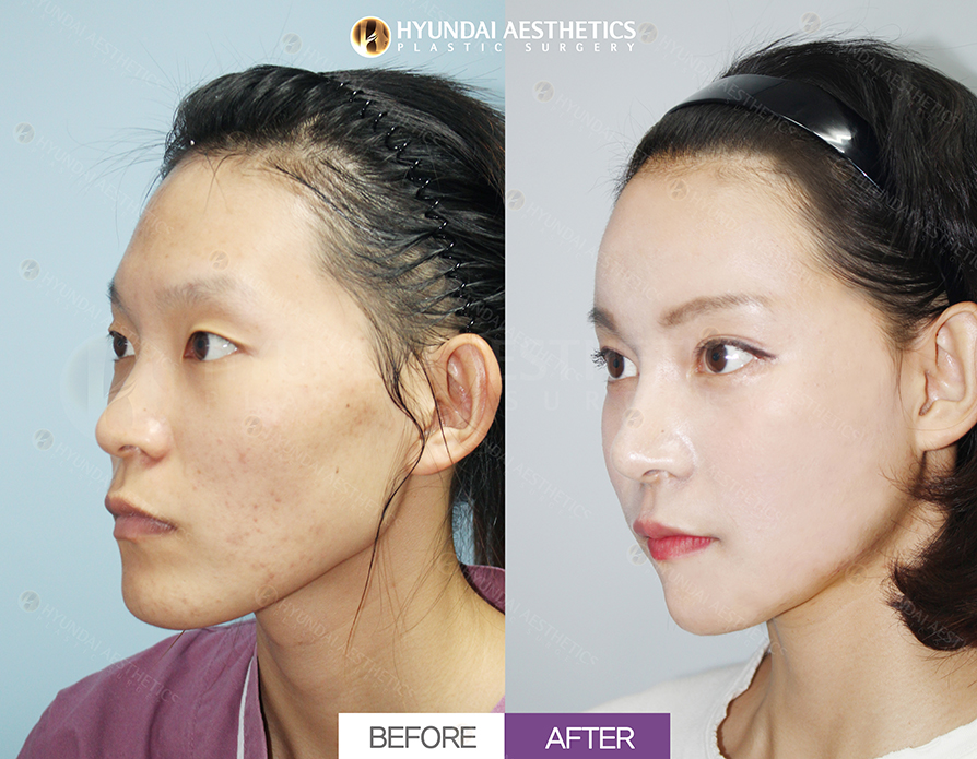 Nang mui thap + Cat xuong ben ngoai + Thu gon canh mui