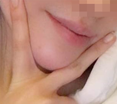 Sau phau thuat dau cam, mat thon gon hon la chuyen co ban, hinh anh cua toi cung thay doi