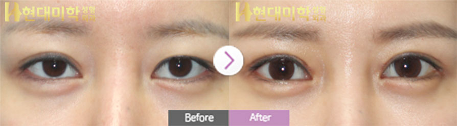 Tái phẫu thuật mắt rạch