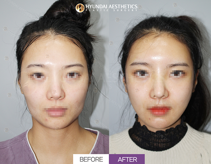 Thu gọn gò má + Thu gọn hàm vuông