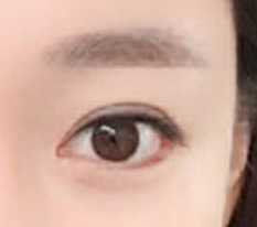 I had revision canthoplasty at Thẩm mỹ Hyundai, the best~