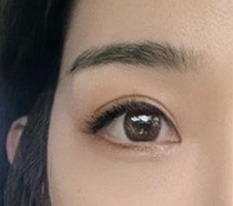 Đây là cơ hội cuối cùng của mình nhưng ca phẫu thuật chỉnh mắt đã thành công ㅎ