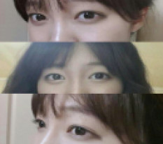 Tôi đã lo rất nhiều về phẫu thuật lại.. giờ có ánh mắt đẹp đầy tự tin ♥