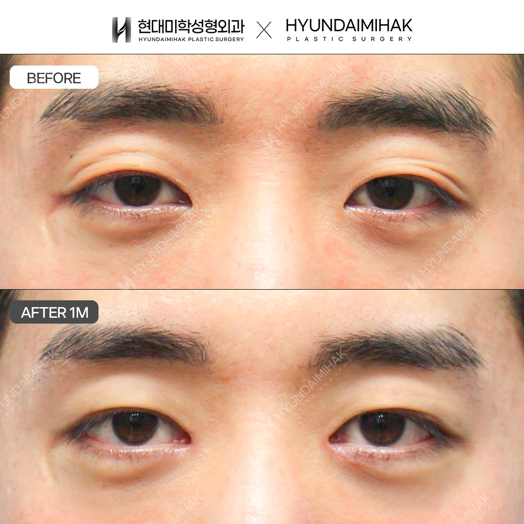 [Phẫu thuật mắt nam] Chỉnh cơ nâng mi không rạch + Mở khóe mắt trong