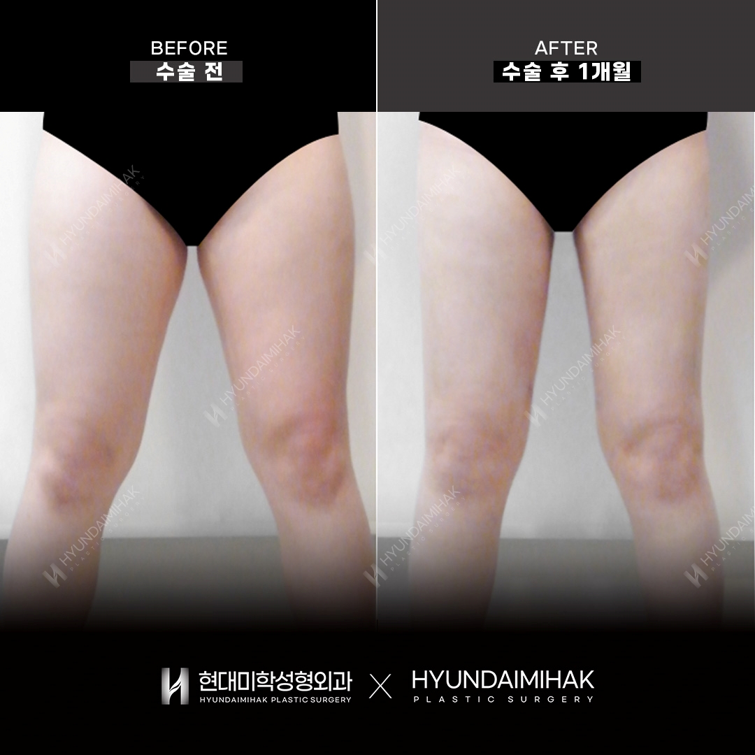 Hút mỡ đùi sau 1 tháng