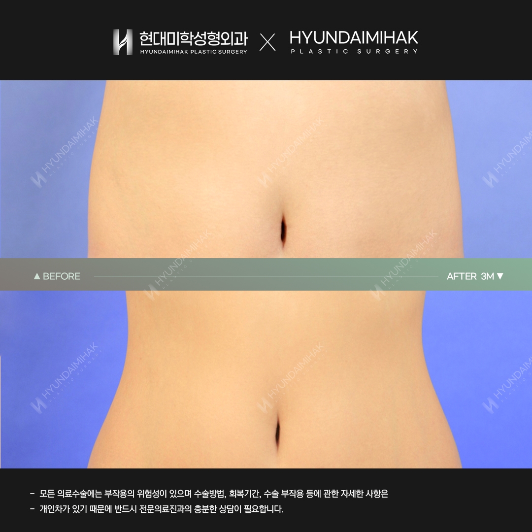 Hút mỡ bụng sau 3 tháng