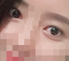 Sửa mắt + chỉnh sụp mí
