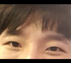 Review phẫu thuật mắt ㅋ