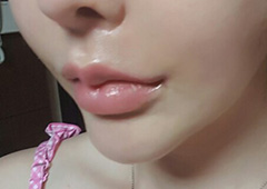 Khóe miệng của mình thay đổi hẳn!!