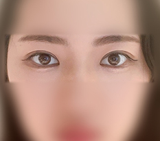 Mắt lệch của tôi đã được cân lại ㅋㅋ