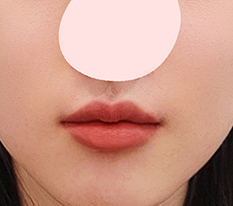Cuối cùng cũng thoát khỏi môi như mề gàㅠㅠㅠ