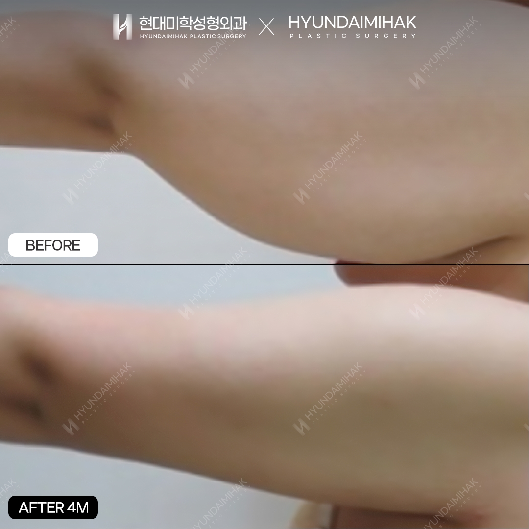 Hút mỡ bắp tay sau 4 tháng