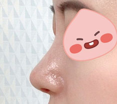 Mới 2 tuần sau phẫu thuật mũi lần 2 mà tôi đã thích lắm rồi ㅎㅎ