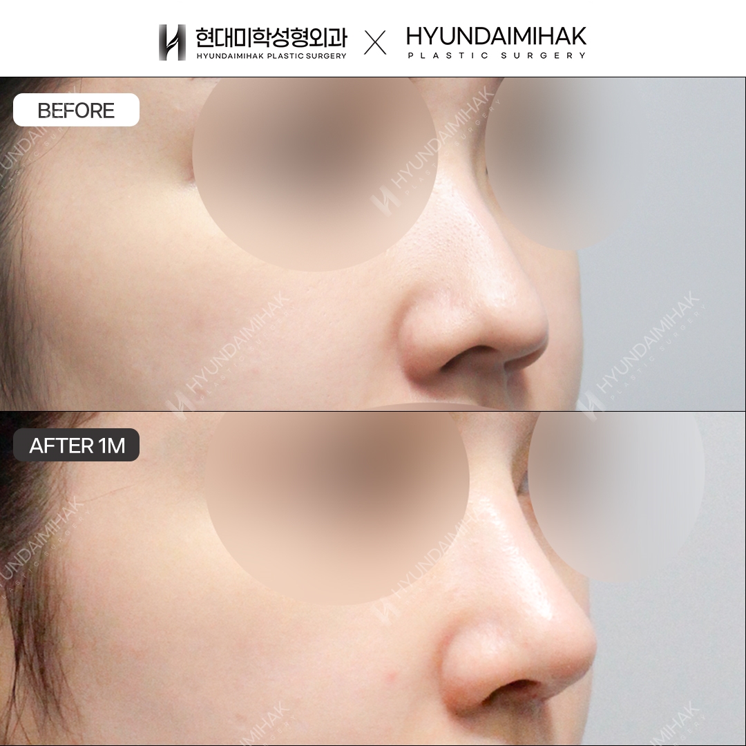 [Phẫu thuật mũi gồ] Sống mũi + đầu mũi sau 1 tháng