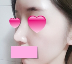 Review phẫu thuật sửa mũi~~