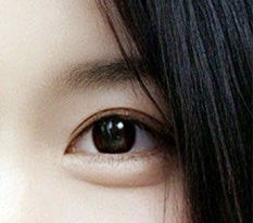 Phẫu thuật mắt lần hai của tôi thành công rồi đúng không?? ㅎㅎ